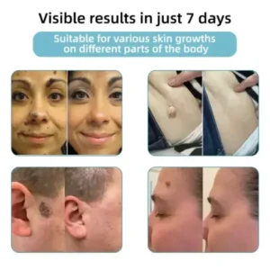BQYOOM™ Non-Invasive Mole and Wart Removal Laser Pen