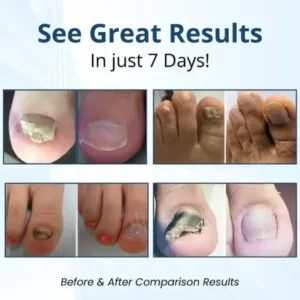 BQYOOM® Pro Fungal Nail Patches